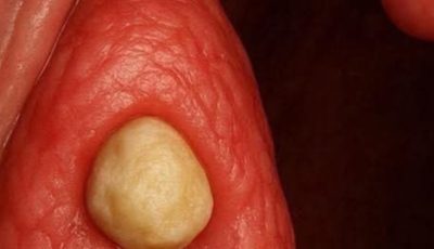 What are those ‘white stones’ that appear in the mouth and cause bad breath?