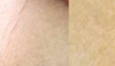 Erased My Age Spots With a Cheap Kitchen Ingredient: Baking Soda