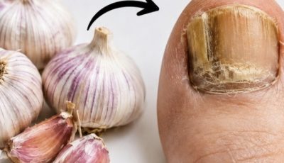 Natural Remedies for Fungal Infections: What Actually Works and What You Should Know